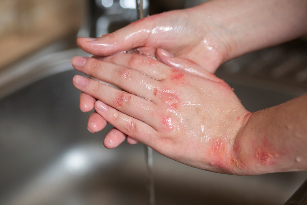 Hands of patient suffering from psoriasis