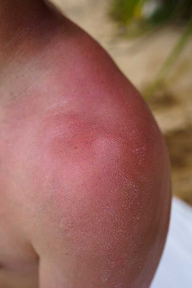 View of man with sunburn skin at the beach