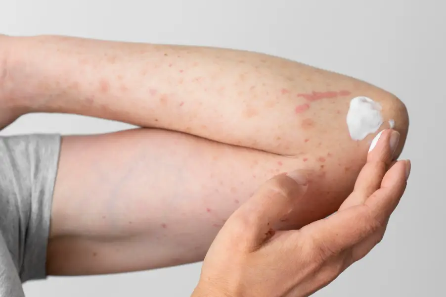 Skin allergy reaction on person's arm